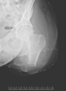 kyle_shortfemur_xray
